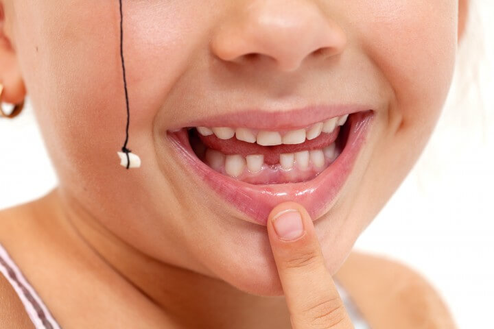 Child pointing to missing teeth, pulled out with a string - clos